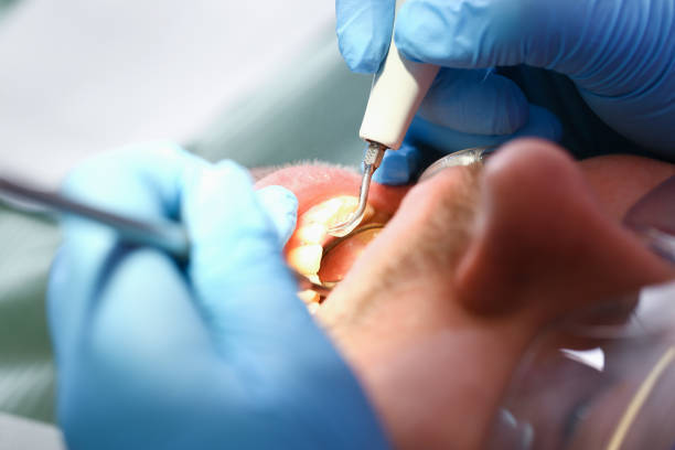 Best Emergency Dental Care for Sports Injuries in Assumption, IL
